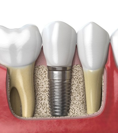 dental implant in Norwalk