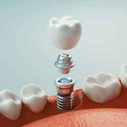 Example of dental implants in Norwalk