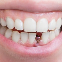 A close-up of a mouth with a single-tooth implant