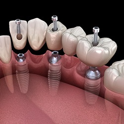 A 3D illustration of a dental bridge secured with three implants 