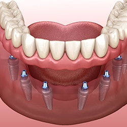 A 3D illustration of an implant denture 