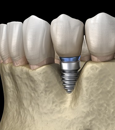 Illustration of bone loss around failed dental implant in Norwalk, OH