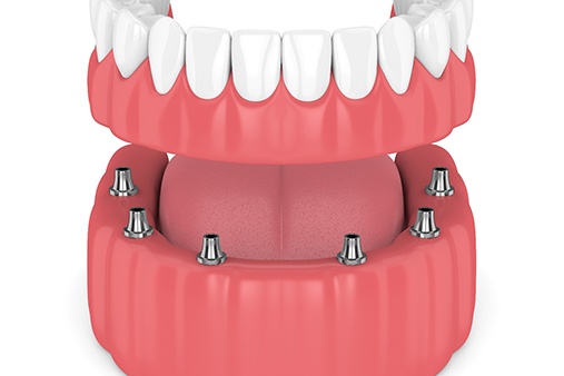Digital model of an implant-retained denture.