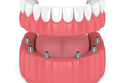 Digital model of an implant-retained denture.