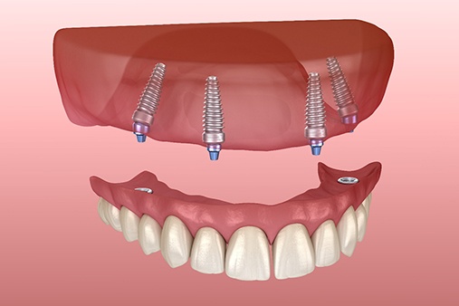 Image of an implant-retained denture.