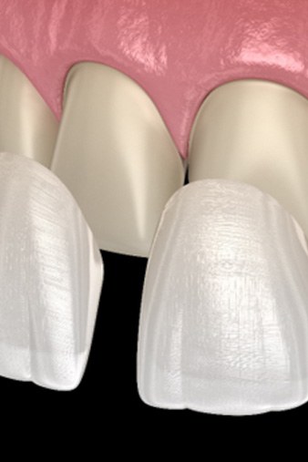 3D illustration of veneers  