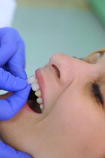 woman getting veneers   