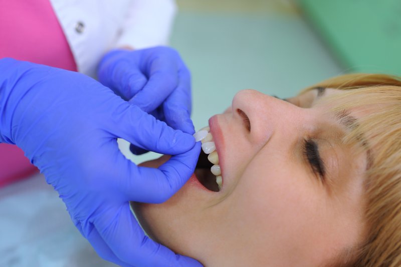 dentist placing veneers on patient 
