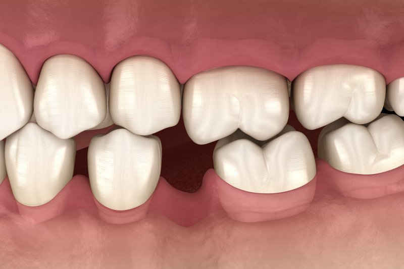 a digital image of teeth shifting in Norwalk