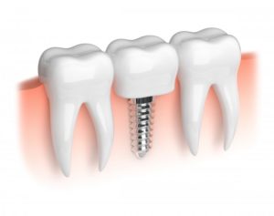 Dental implant.