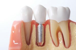 Model of a dental implant