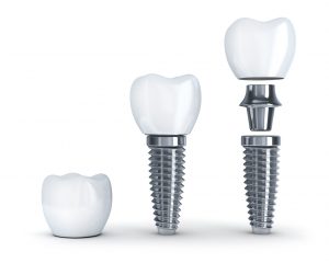 Three parts to dental implant