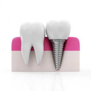 Dental implants can bring harmony back to your oral health.