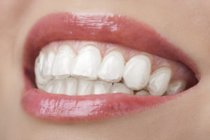 clear aligners